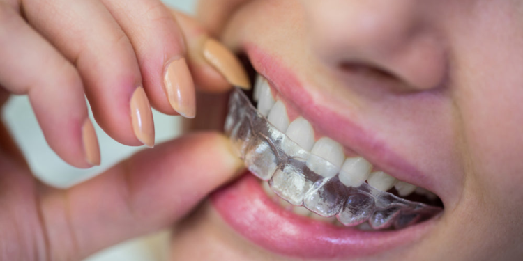 Life After Aligners: Why Your Retainer Is Your New Best Friend