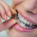 Life After Aligners: Why Your Retainer Is Your New Best Friend