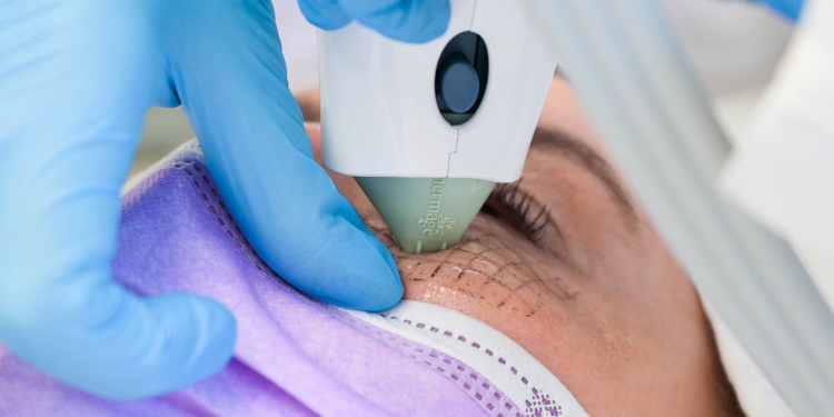 Unlock Radiant Skin with Thermage: The Ultimate Skin Tightening Solution