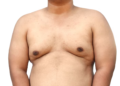 What to Expect from Gynaecomastia Reduction Surgery Sydney