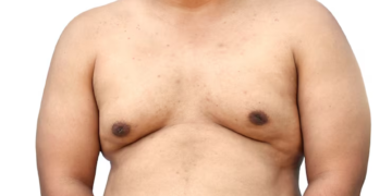 What to Expect from Gynaecomastia Reduction Surgery Sydney