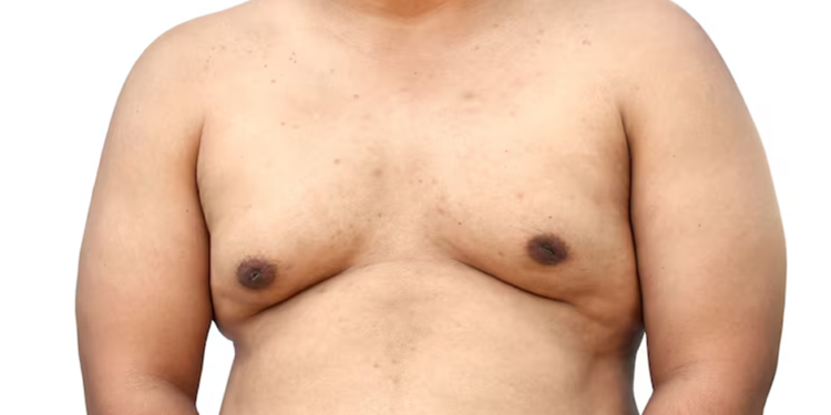 What to Expect from Gynaecomastia Reduction Surgery Sydney