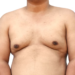 What to Expect from Gynaecomastia Reduction Surgery Sydney