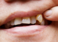 Why a Chipped Tooth Is Never as Harmless as It Looks