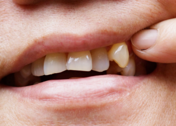 Why a Chipped Tooth Is Never as Harmless as It Looks