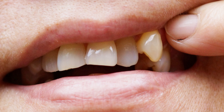 Why a Chipped Tooth Is Never as Harmless as It Looks