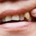 Why a Chipped Tooth Is Never as Harmless as It Looks