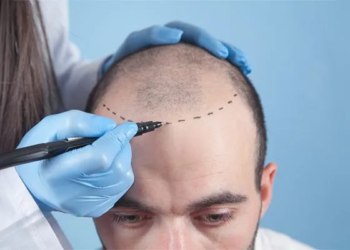 How Much Does a Hair Transplant Cost in Turkey? A Complete Guide for 2026