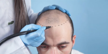 How Much Does a Hair Transplant Cost in Turkey? A Complete Guide for 2026