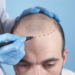 How Much Does a Hair Transplant Cost in Turkey? A Complete Guide for 2026