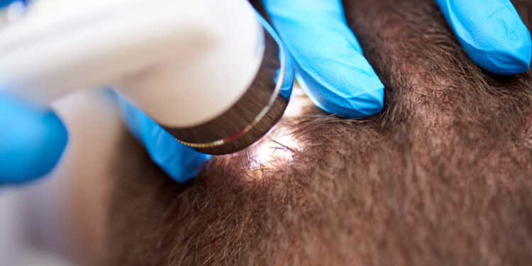 Discover the Power of Scalp Micropigmentation for Fuller Hair in Miami