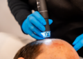 Achieving Fuller Hair Without Surgery: Scalp Micropigmentation in Miami
