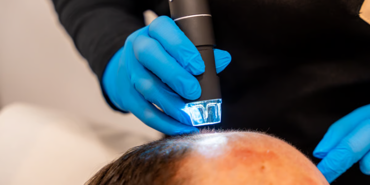 Achieving Fuller Hair Without Surgery: Scalp Micropigmentation in Miami