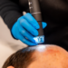 Achieving Fuller Hair Without Surgery: Scalp Micropigmentation in Miami