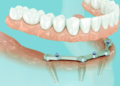 The Comprehensive Guide to All on 4 Dental Implants