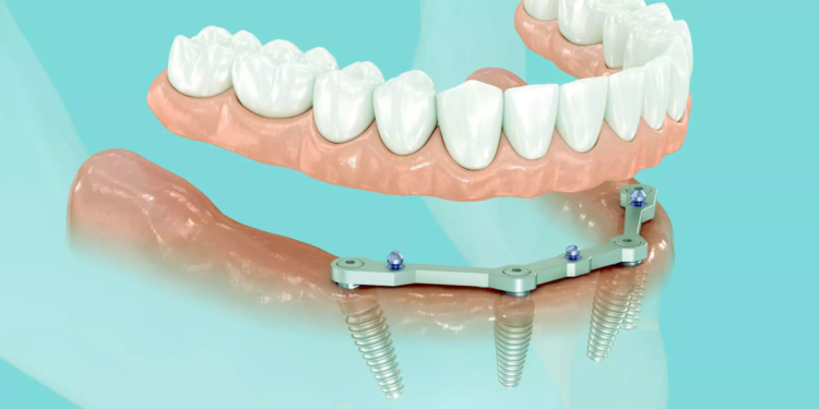The Comprehensive Guide to All on 4 Dental Implants