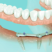 The Comprehensive Guide to All on 4 Dental Implants