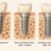 Why Titanium Became the Metal Your Body Agrees to Keep